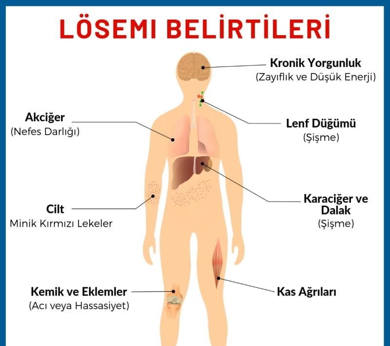 Lösemi belirtileri nelerdir