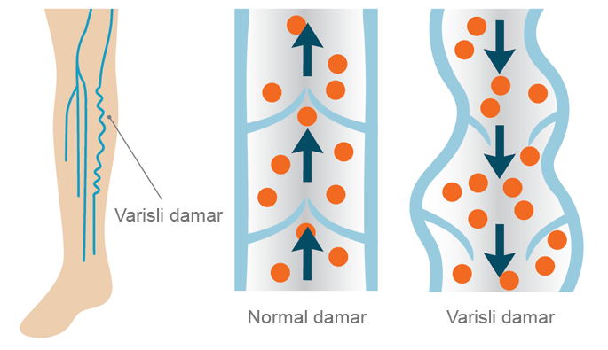 Varis Nedir? Varis Neden Olur, Tedavisi Nasıldır?